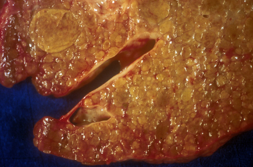 Hépatite inflammation du foie